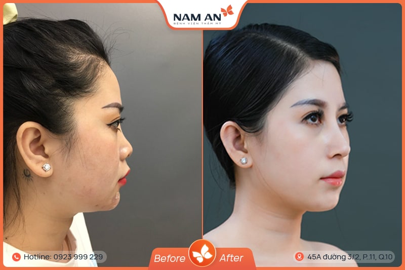 Nâng Mũi Bọc Sụn Tự Nhiên, Ngăn Biến Chứng Tại Nam An (5)