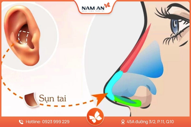 Nâng Mũi Bọc Sụn Tự Nhiên, Ngăn Biến Chứng Tại Nam An (7)