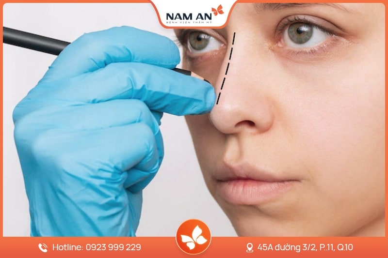 Nâng Mũi Bọc Sụn Tự Nhiên, Ngăn Biến Chứng Tại Nam An (9)