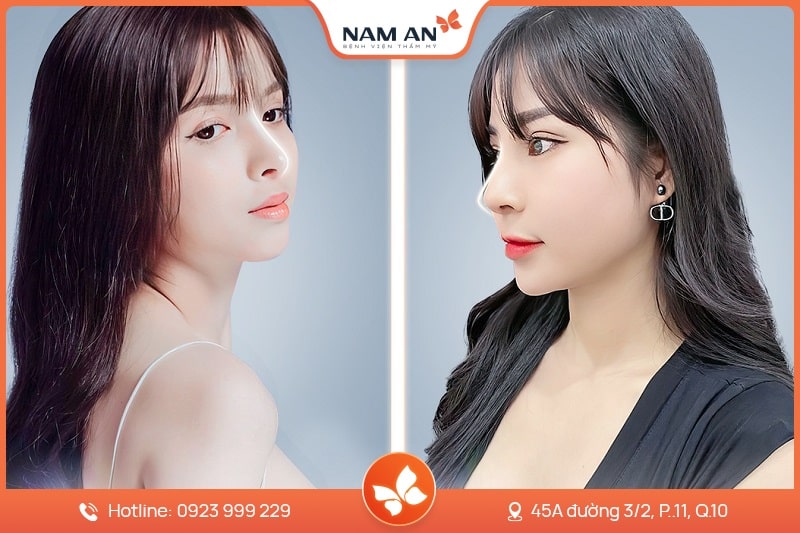 Nâng Mũi Cấu Trúc Toàn Diện (11)