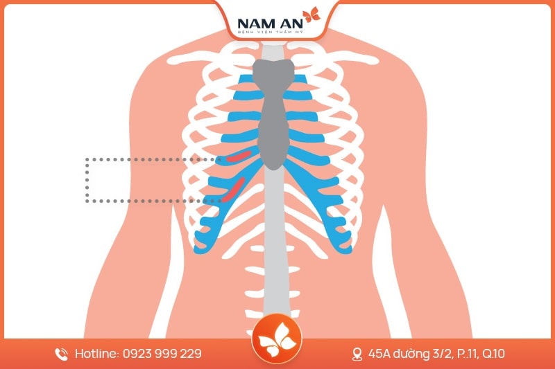 Nâng Mũi Cấu Trúc Toàn Diện (12)