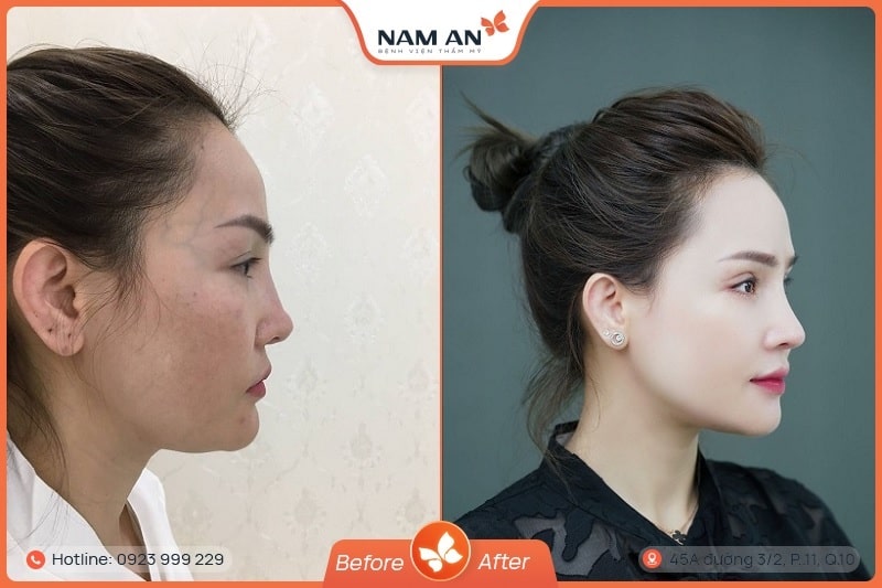 Nâng Mũi Cấu Trúc Toàn Diện (5)