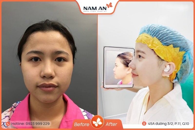Nâng Mũi Cấu Trúc Toàn Diện (6)
