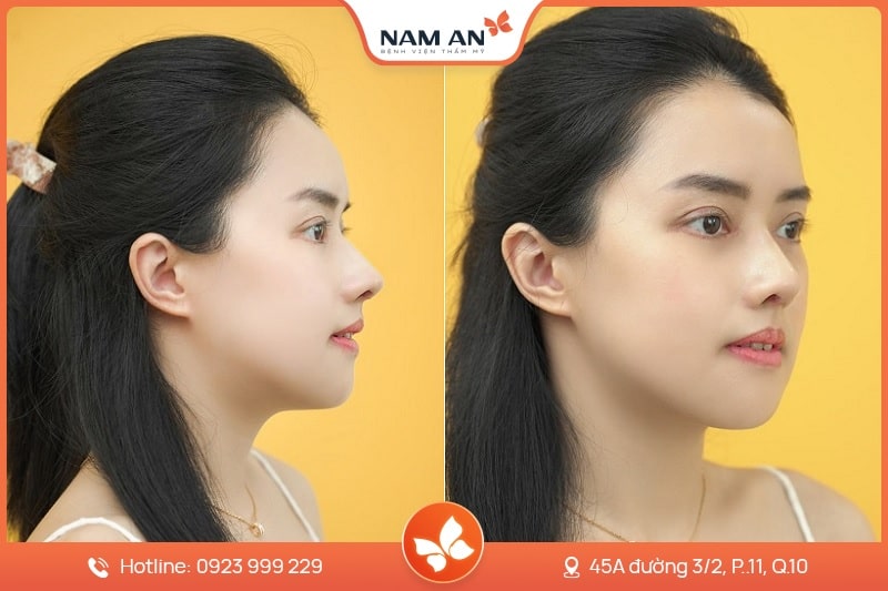 Nâng Mũi Cấu Trúc Toàn Diện (7)