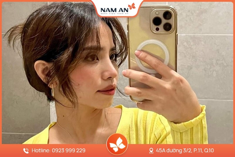 Nâng Mũi Cấu Trúc Toàn Diện (9)