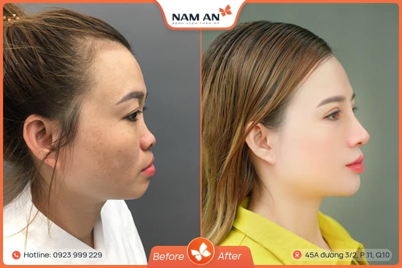 Nâng Mũi S-Line Cấu Trúc Khởi Tạo Đường Cong Mềm Mại (10)