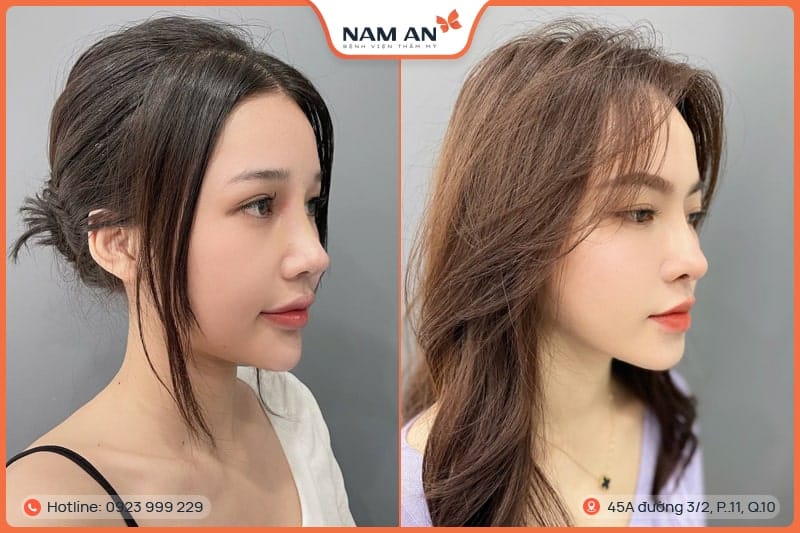 Nâng Mũi S-Line Cấu Trúc Khởi Tạo Đường Cong Mềm Mại (16)
