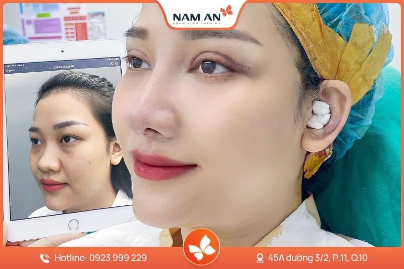 Nâng Mũi S-Line Cấu Trúc Khởi Tạo Đường Cong Mềm Mại (18)