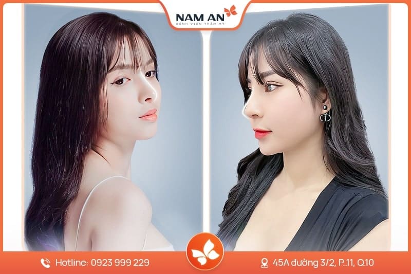 Nâng Mũi S-Line Cấu Trúc Khởi Tạo Đường Cong Mềm Mại (5)
