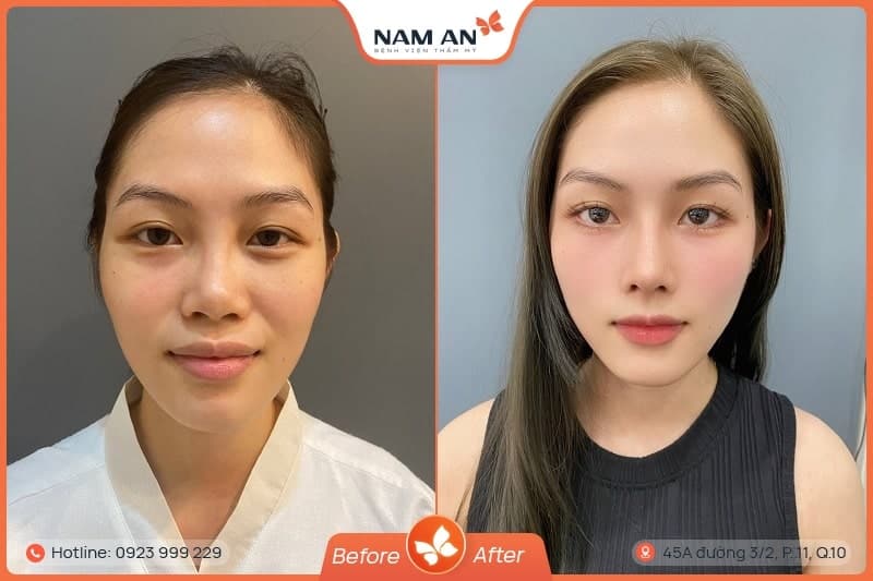 Nâng Mũi S-Line Cấu Trúc Khởi Tạo Đường Cong Mềm Mại (9)