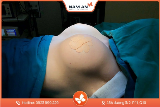 Nâng Ngực Bằng Mỡ Tự Thân Có Bền Không Giữ Được Lâu Không (2)