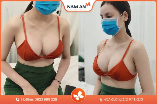 Nâng Ngực Bằng Mỡ Tự Thân Có Bền Không Giữ Được Lâu Không (4)
