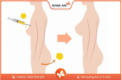 Nâng Ngực Bằng Mỡ Tự Thân Có Bền Không? Giữ Được Lâu Không?