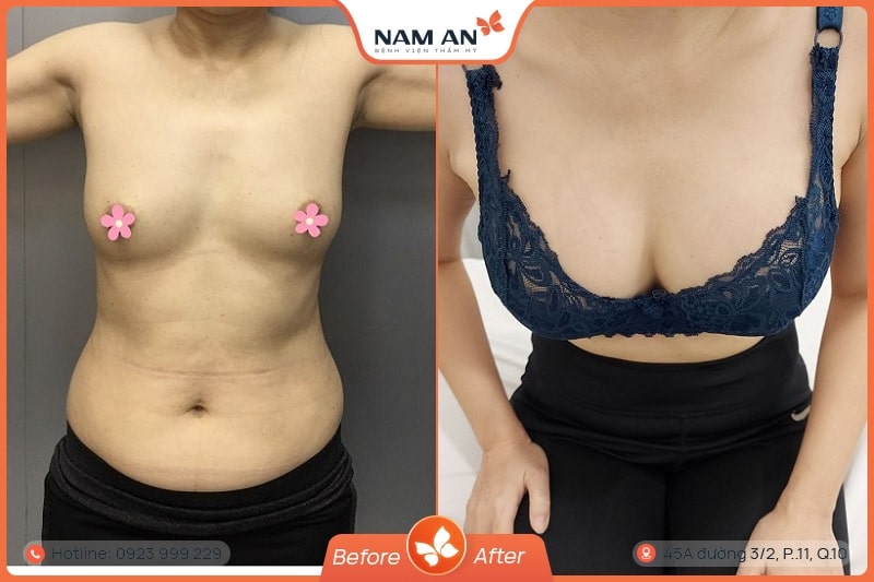 Nâng Ngực Bằng Mỡ Tự Thân Tự Nhiên Chuẩn Y Khoa Tại Nam An (5)
