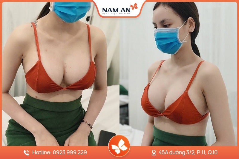 Nâng Ngực Bằng Mỡ Tự Thân Tự Nhiên Chuẩn Y Khoa Tại Nam An (6)