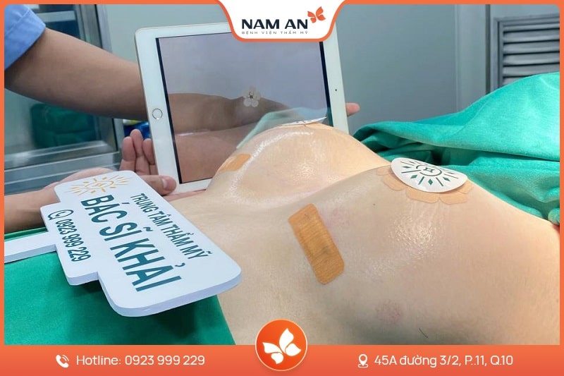 Nâng Ngực Bằng Mỡ Tự Thân Tự Nhiên Chuẩn Y Khoa Tại Nam An (7)
