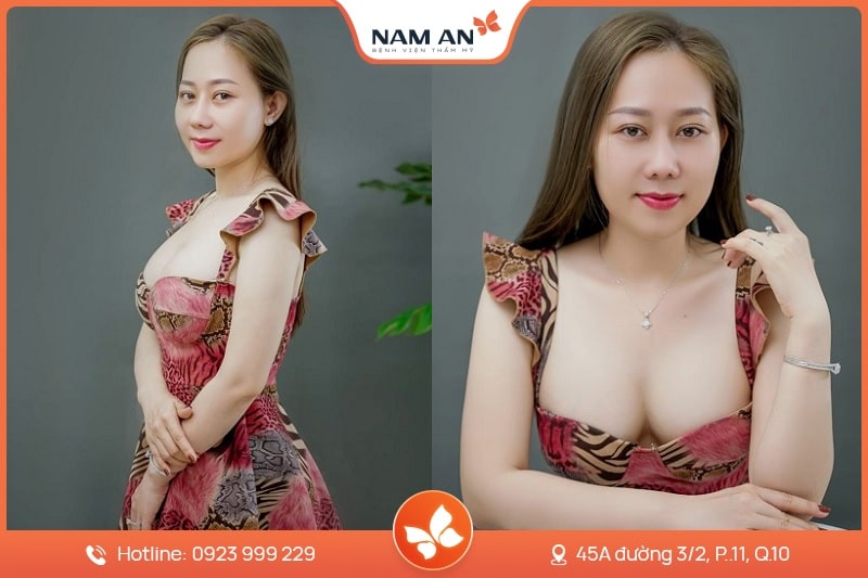 Nâng Ngực Bằng Mỡ Tự Thân Tự Nhiên Chuẩn Y Khoa Tại Nam An (9)