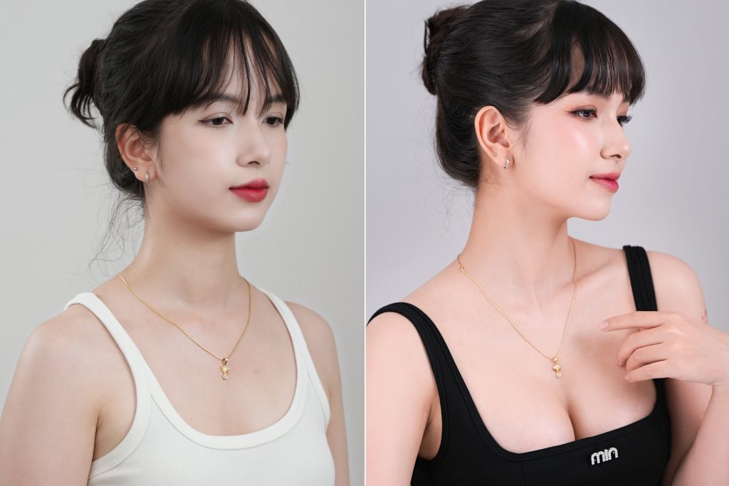 Nâng Ngực Chuẩn Phác Đồ ERAS Phục Hồi Nhanh Tại Nam An (2)