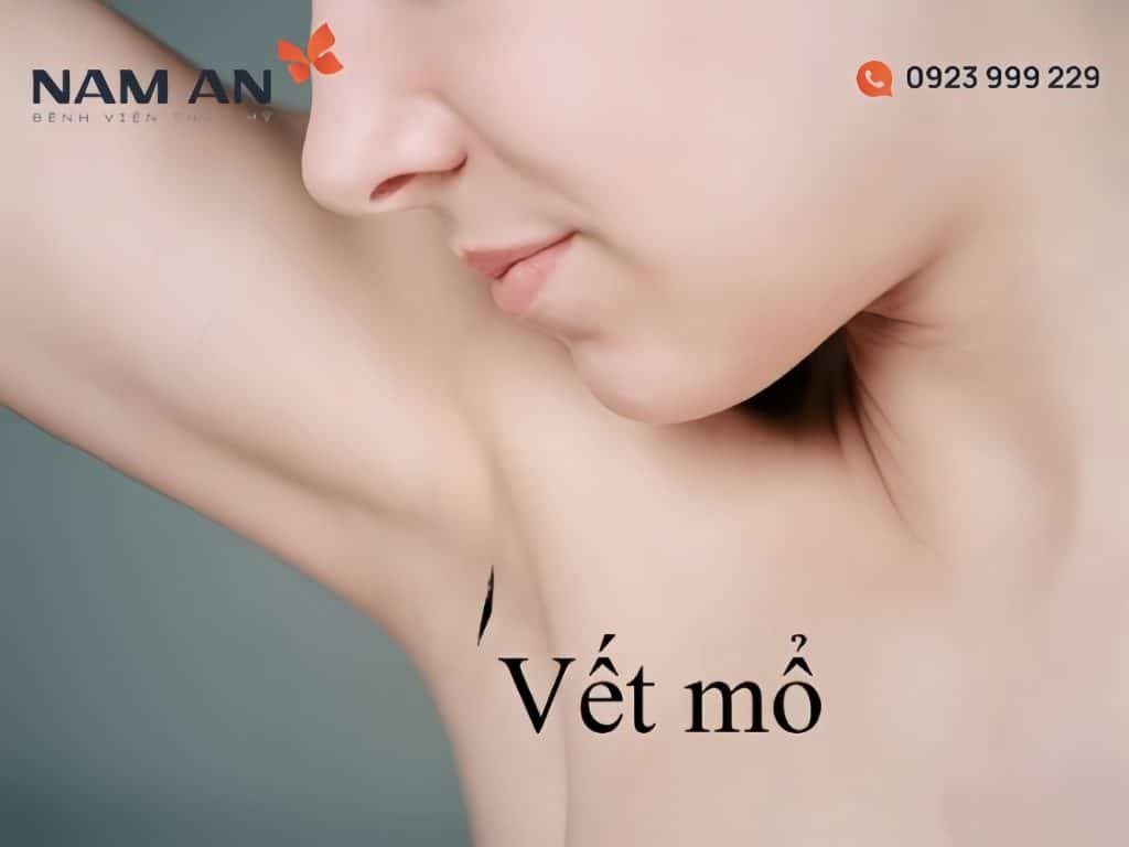 Nâng Ngực Đường Nách Ưu Nhược Điểm Và Lưu Ý Cần Biết