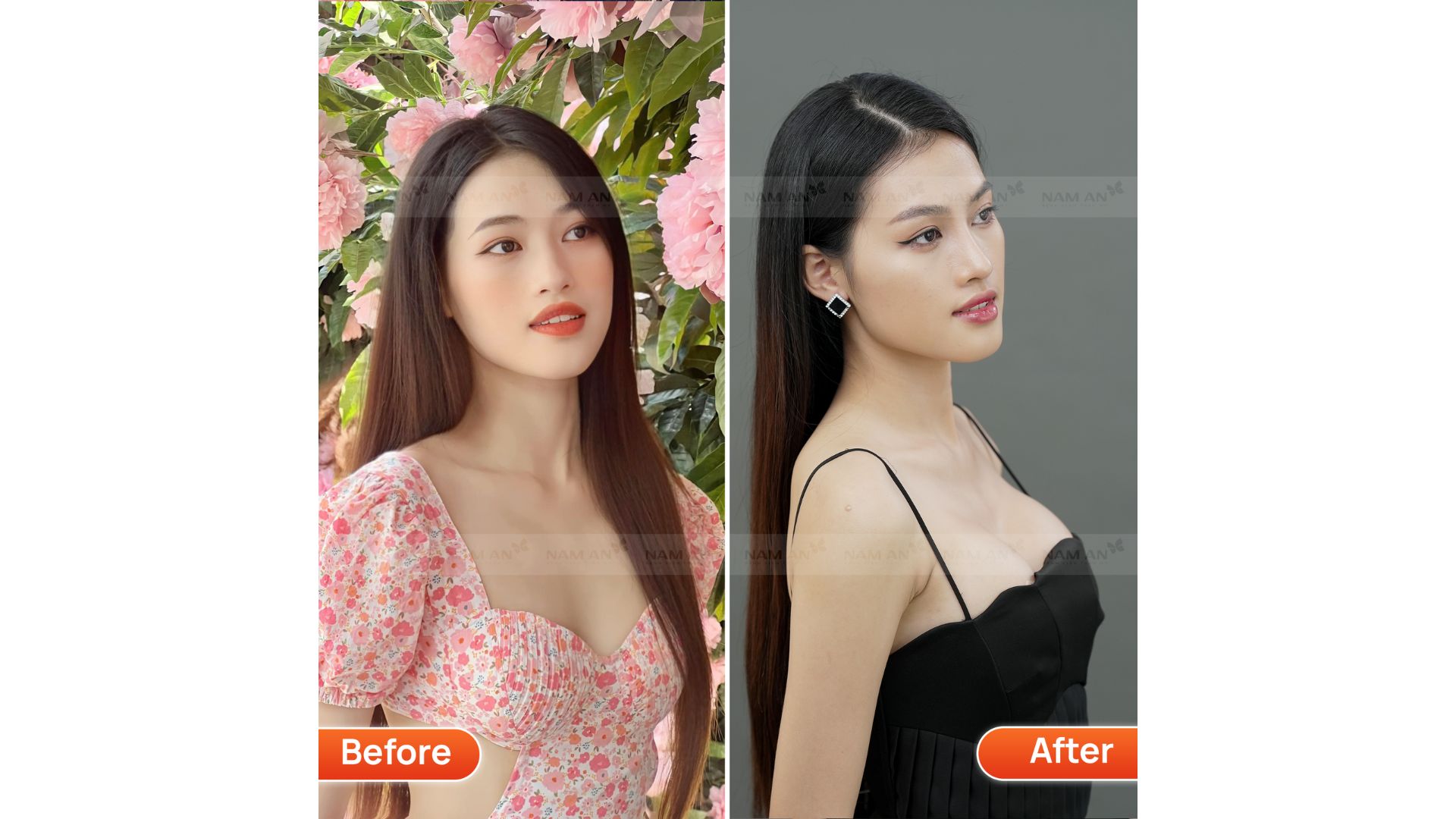 Nâng Ngực Không Chạm - Kỹ Thuật Đột Phá Tại Thẩm Mỹ Nam An