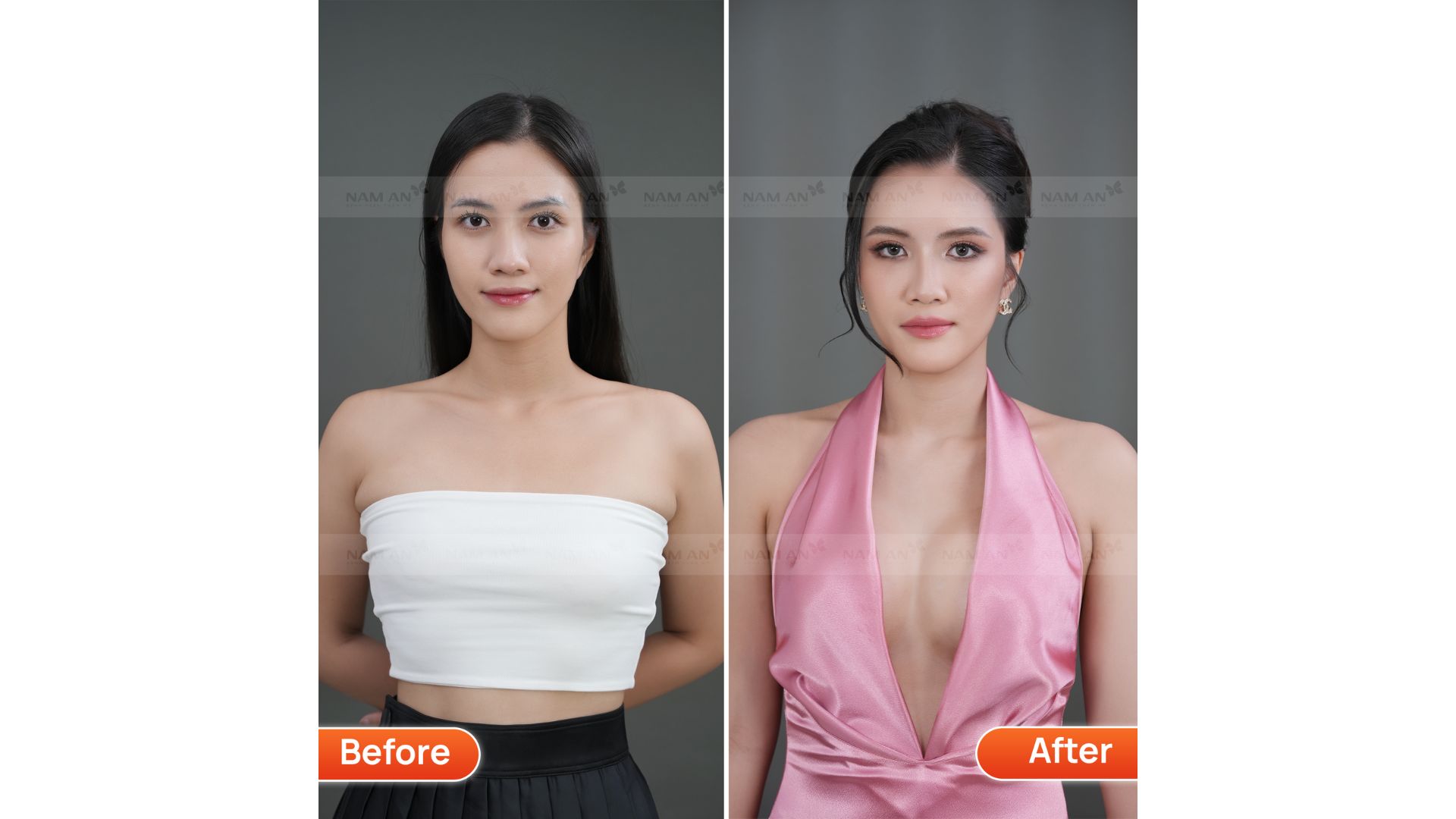Nâng Ngực Size Bao Nhiêu Thì Đẹp Cách Chọn Size Ngực (2)