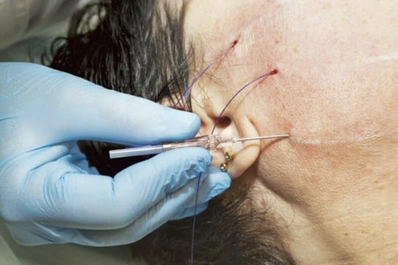 Nên Căng Chỉ Hay Căng Da Mặt Phẫu Thuật So Sánh Chi Tiết (2)