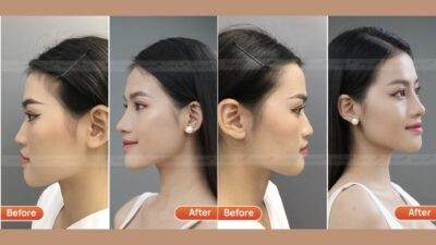 Nên Chọn Loại Sụn Nào Khi Nâng Mũi? Tư Vấn Chuyên Sâu
