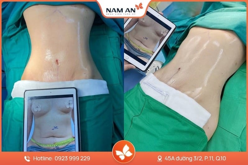 Những Điều Cần Biết Trước Khi Phẫu Thuật Hút Mỡ (2)