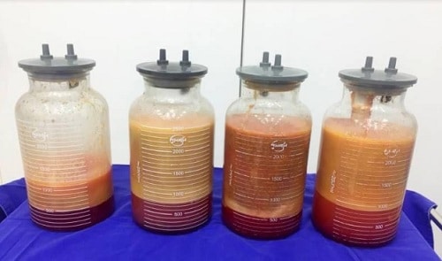 Những Điều Cần Biết Trước Khi Phẫu Thuật Hút Mỡ
