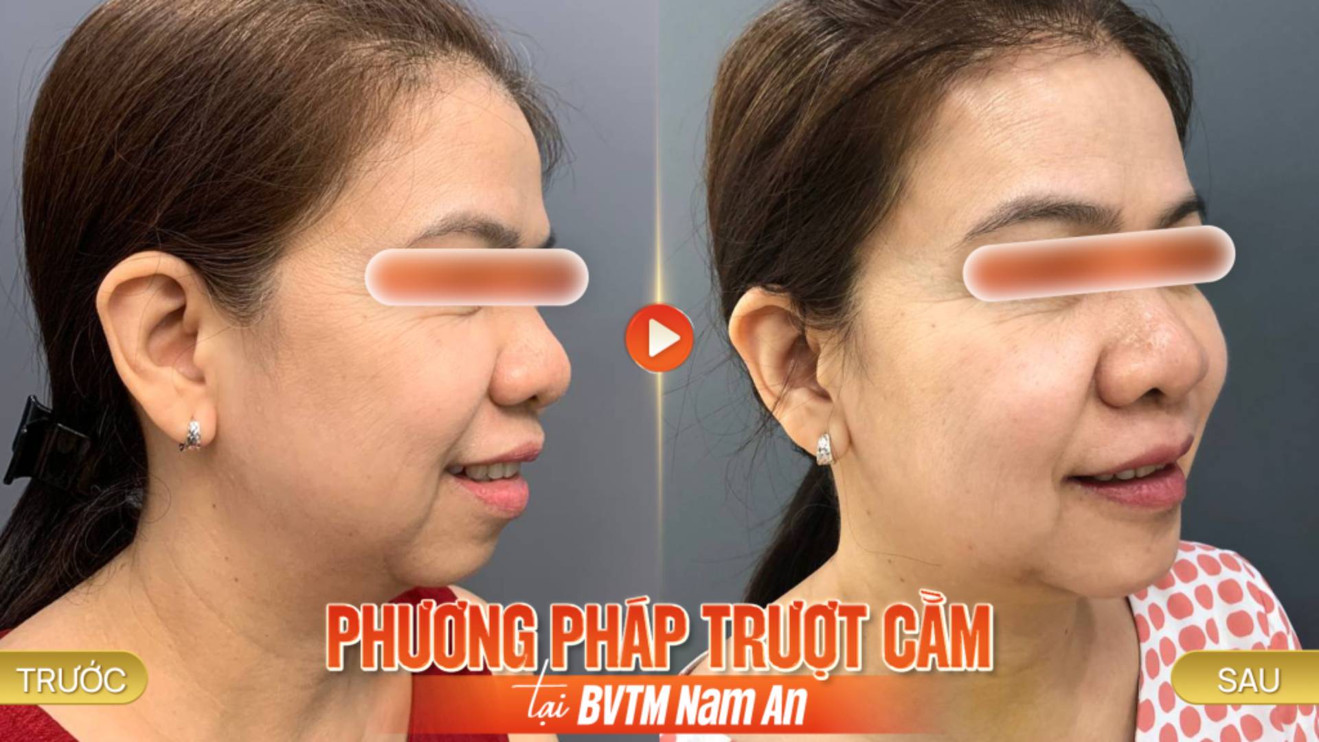 Những Điều Cần Biết Trước Khi Phẫu Thuật Trượt Cằm (1)