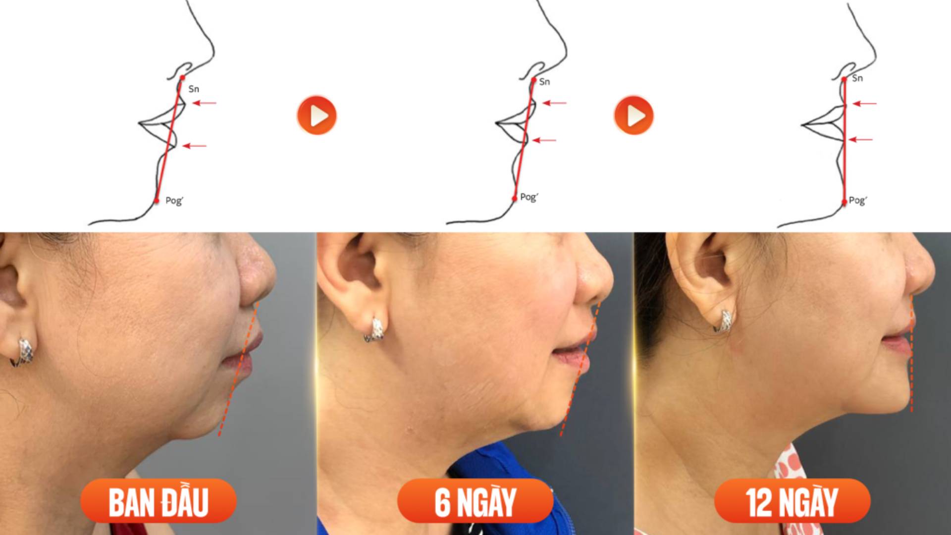 Những Điều Cần Biết Trước Khi Phẫu Thuật Trượt Cằm