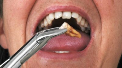 Những Điều Cần Biết Trước Và Sau Khi Nhổ Răng Khôn