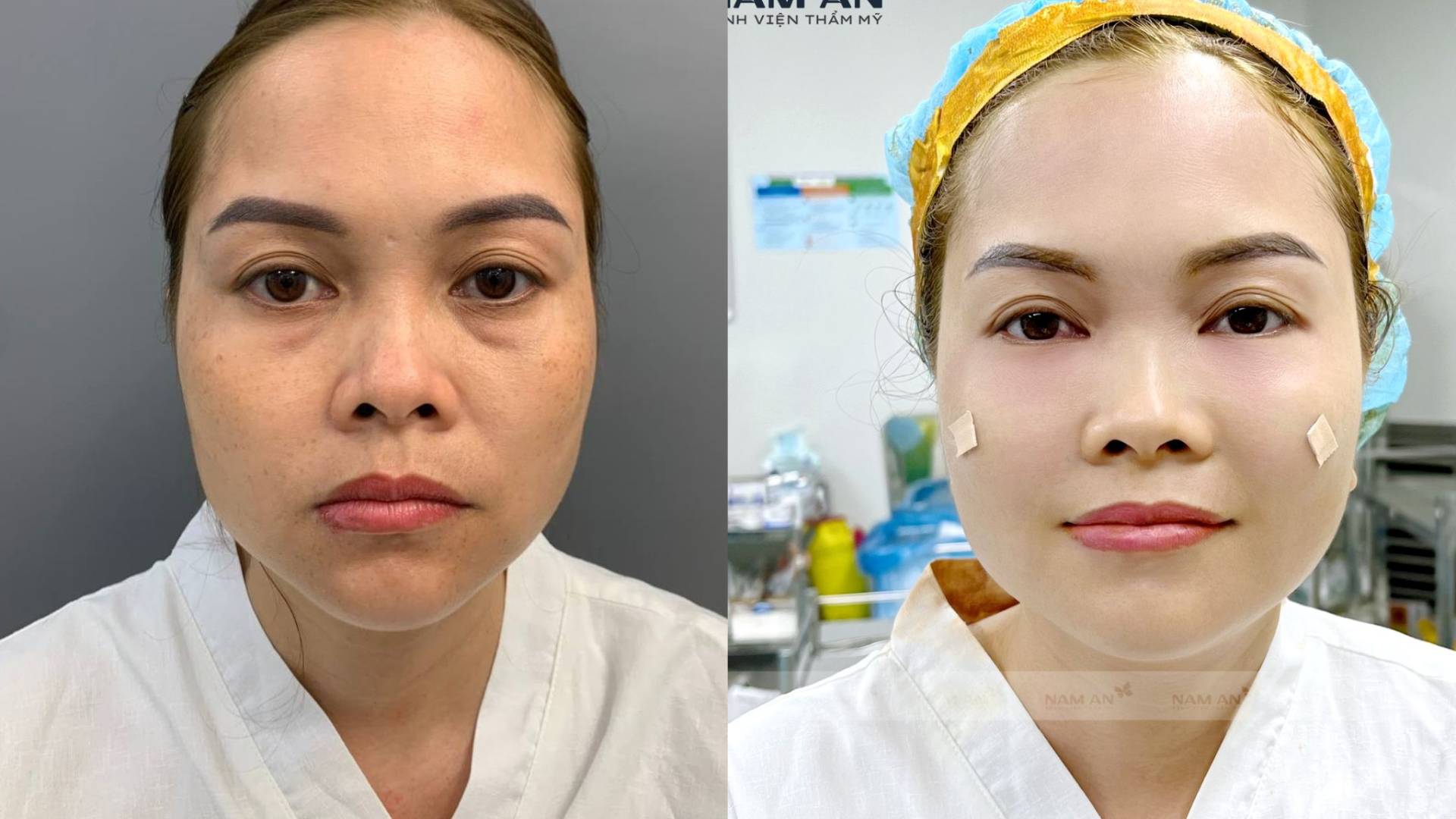 Những Lưu Ý Quan Trọng Khi Thực Hiện Cấy Mỡ Tự Thân (4)