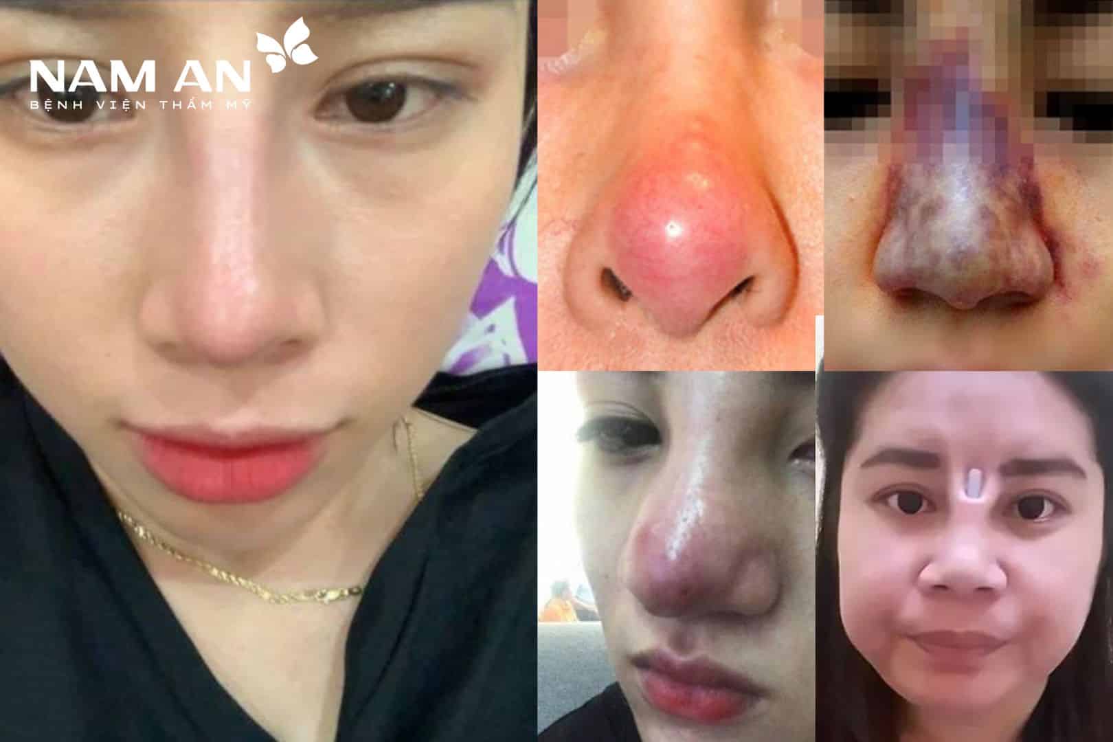 Những triệu chứng sau khi nâng mũi là bình thường