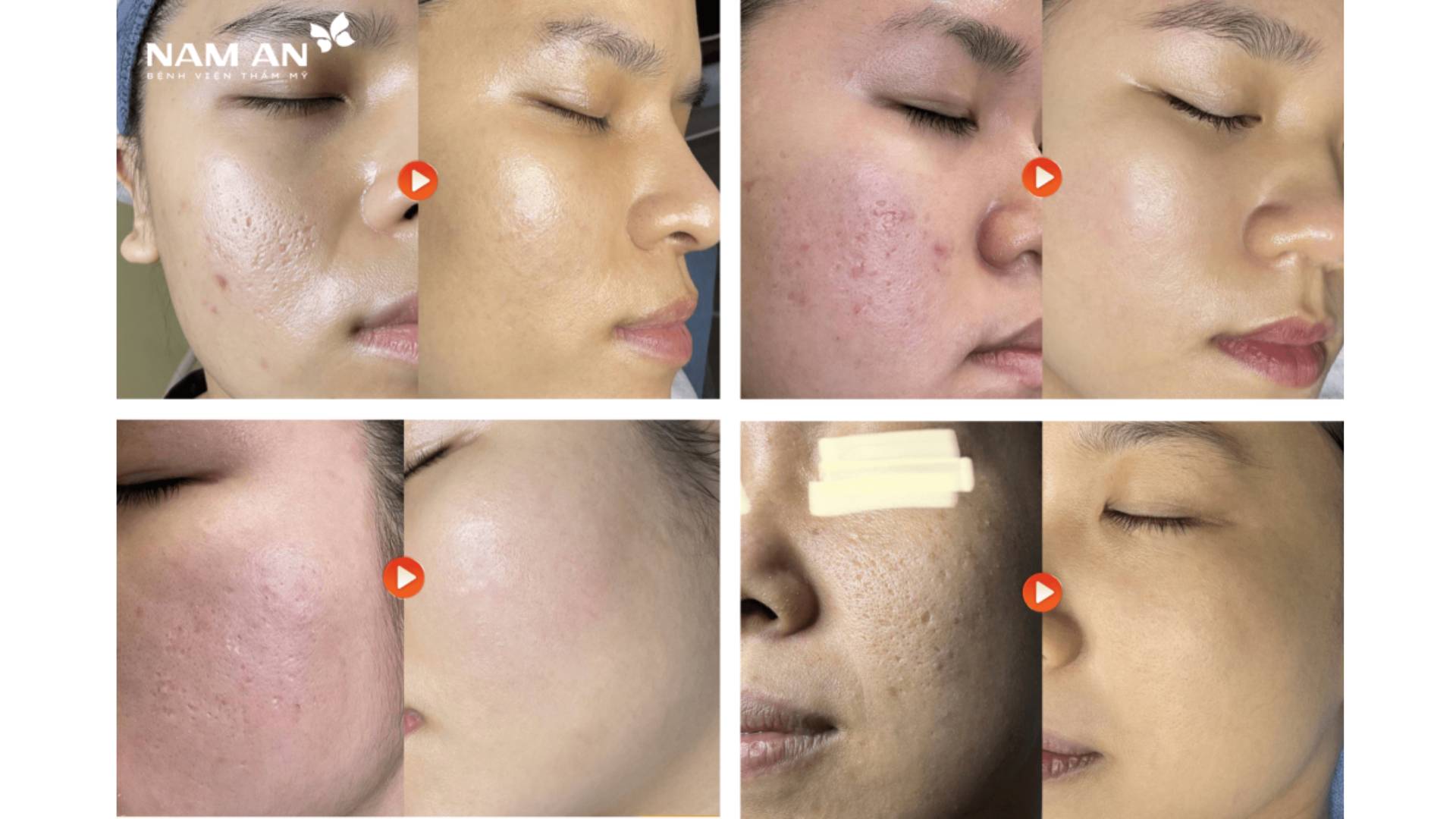 Peel da – Thanh lọc và tái tạo làn da (3)