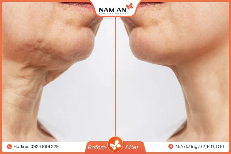 Phẫu Thuật Căng Da Cổ Xóa Nhăn, Nâng Cơ Tại BVTM Nam An (5)