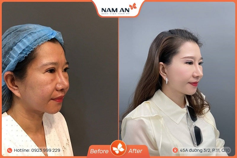 Phẫu Thuật Căng Da Cổ Xóa Nhăn, Nâng Cơ Tại BVTM Nam An (7)