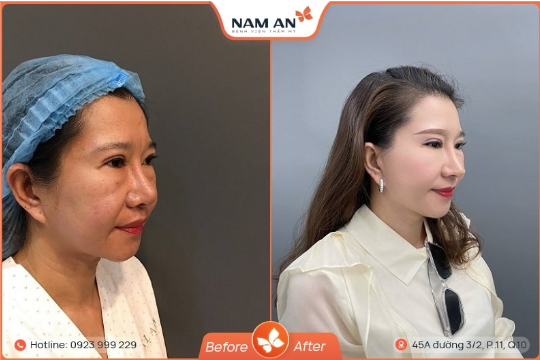Phẫu Thuật Căng Da Mặt Có Cải Thiện Sự Lão Hóa Không (2)