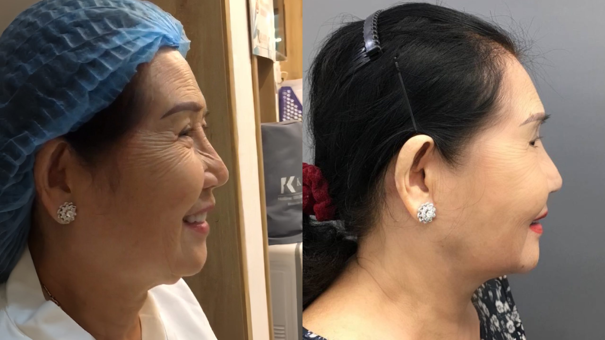 Phẫu Thuật Căng Da Mặt Có Cải Thiện Sự Lão Hóa Không