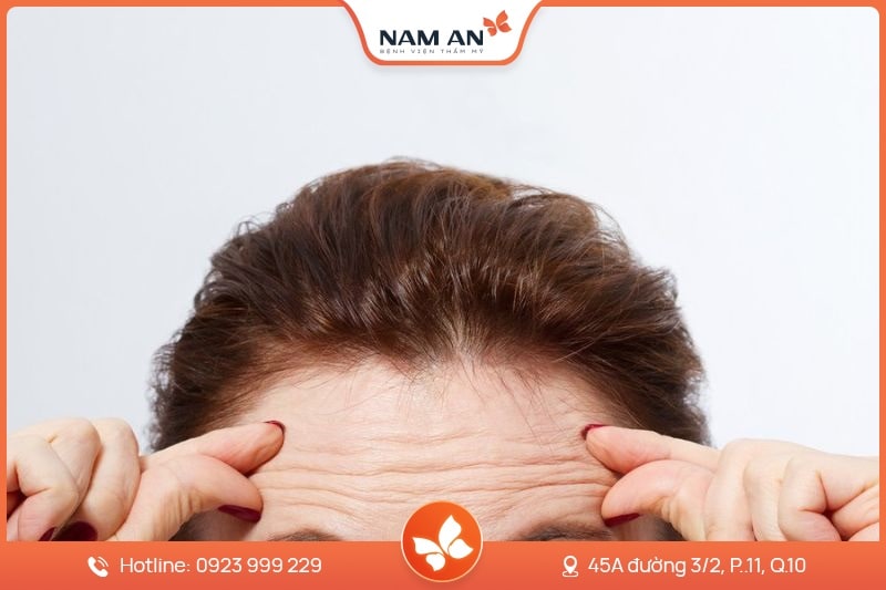 Phẫu Thuật Căng Da Trán Xóa Nhăn Hiệu Quả Tại Nam An (5)