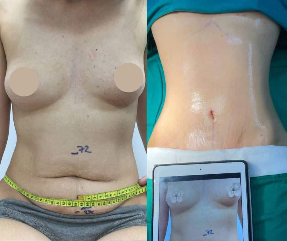 Phẫu Thuật Cắt Da Tạo Hình Thành Bụng Tại BVTM Nam An (2)
