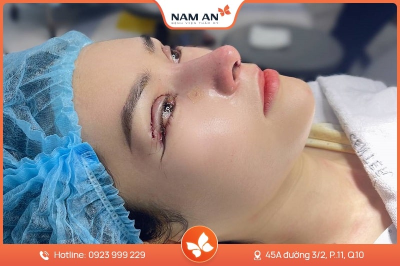 Phẫu Thuật Cắt Mắt 2 Mí Đẹp Tự Nhiên Tại BVTM Nam An (4)