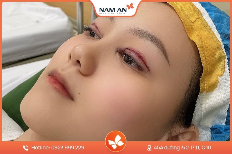 Phẫu Thuật Cắt Mắt 2 Mí Đẹp Tự Nhiên Tại BVTM Nam An (4)