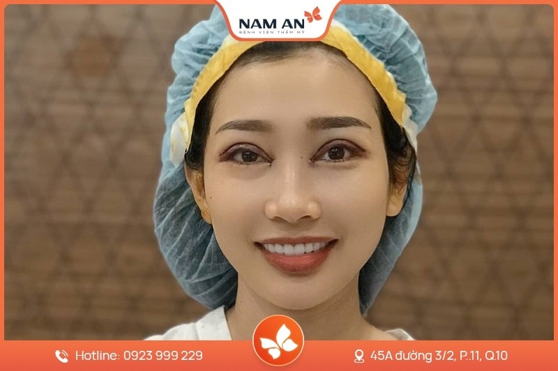 Phẫu Thuật Cắt Mắt 2 Mí Đẹp Tự Nhiên Tại BVTM Nam An (4)