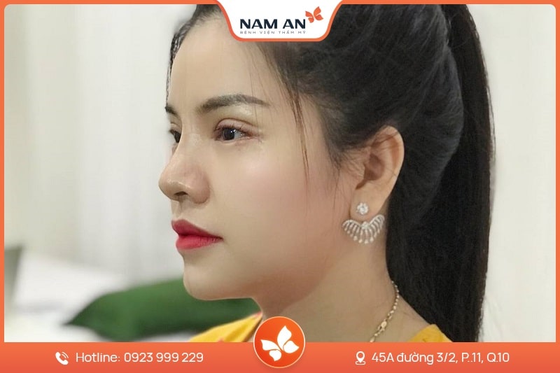 Phẫu Thuật Cắt Mắt 2 Mí Đẹp Tự Nhiên Tại BVTM Nam An (4)