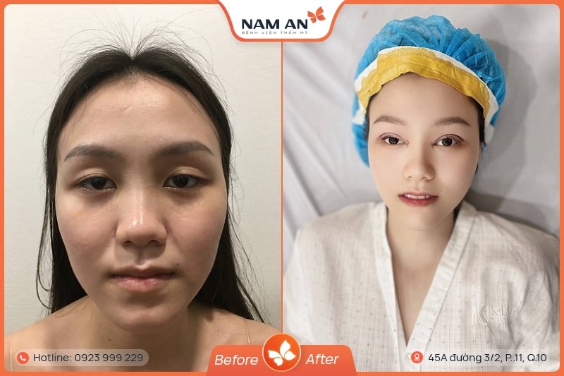 Phẫu Thuật Cắt Mắt 2 Mí Đẹp Tự Nhiên Tại BVTM Nam An (4)