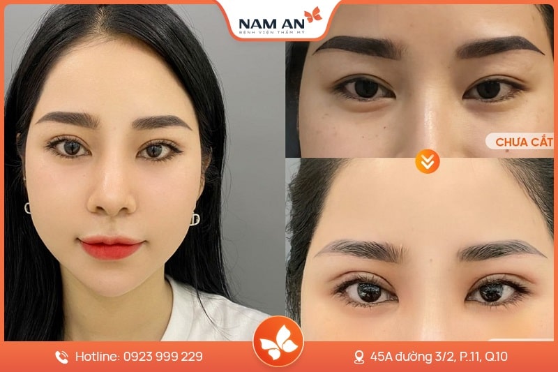 Phẫu Thuật Cắt Mắt 2 Mí Đẹp Tự Nhiên Tại BVTM Nam An (4)