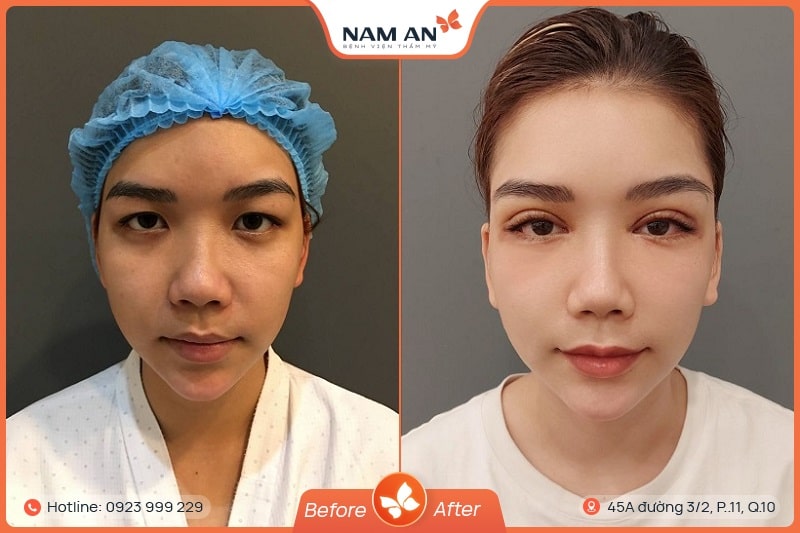 Phẫu Thuật Cắt Mắt 2 Mí Đẹp Tự Nhiên Tại BVTM Nam An (4)
