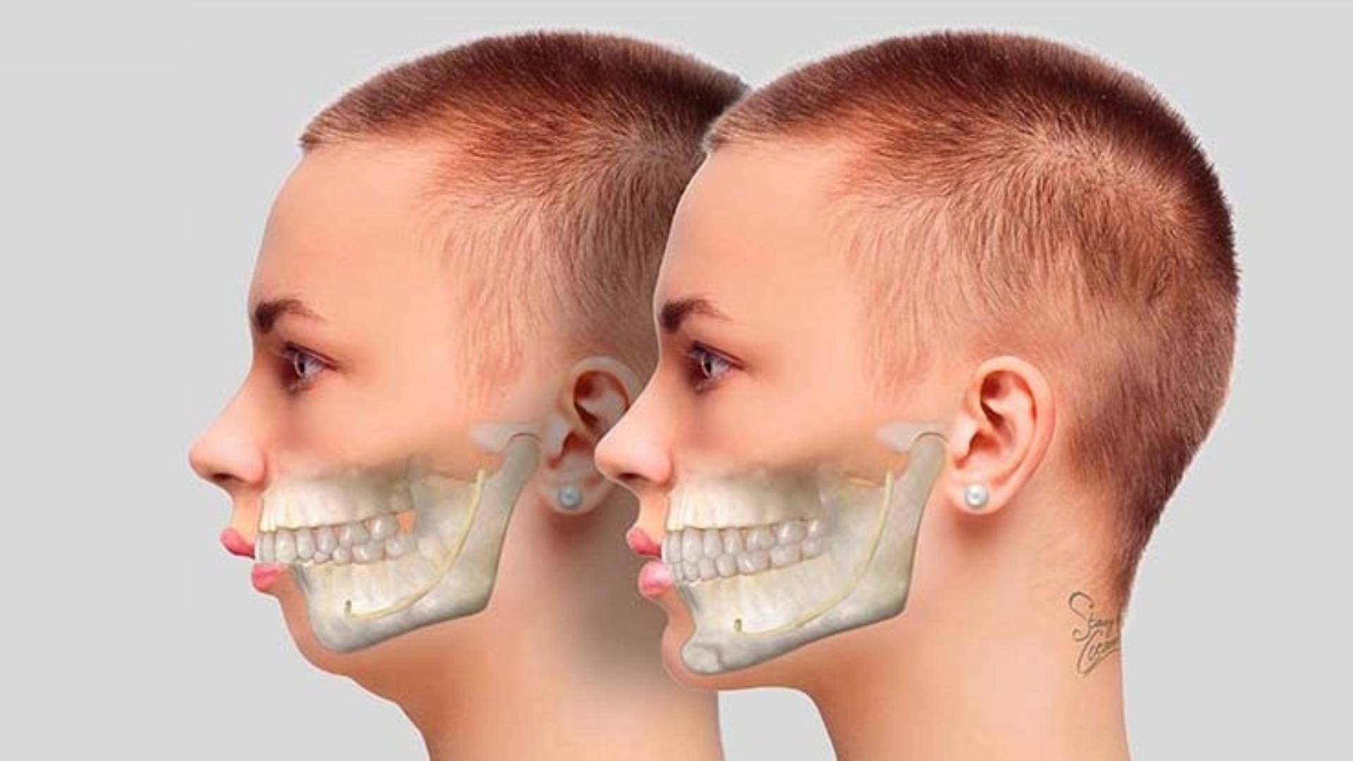 Phẫu Thuật Chỉnh Hàm Hô Có Nguy Hiểm Không_ Lưu Ý Cần Biết