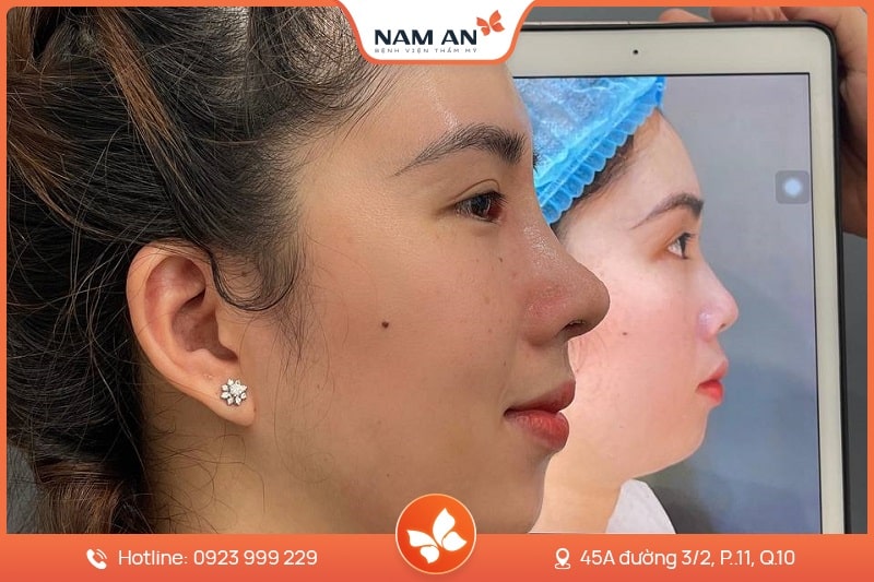 Phẫu Thuật Chỉnh Hàm Hô Khắc Phục Triệt Để Tại Nam An (1)
